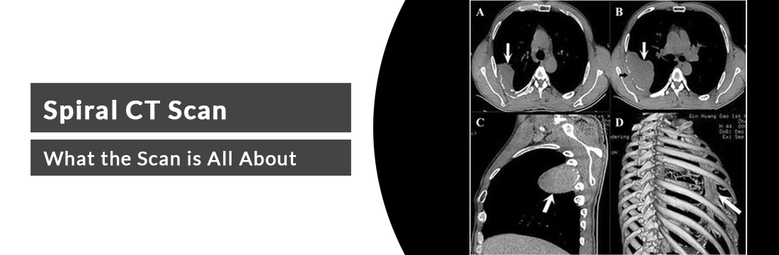 Spiral CT Scan: What the Scan is All About